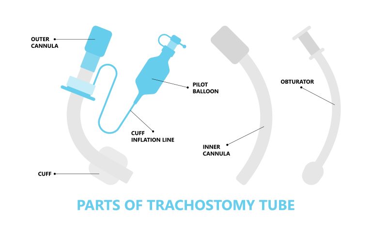Image identifying parts and pieces of a tracheostomy tube