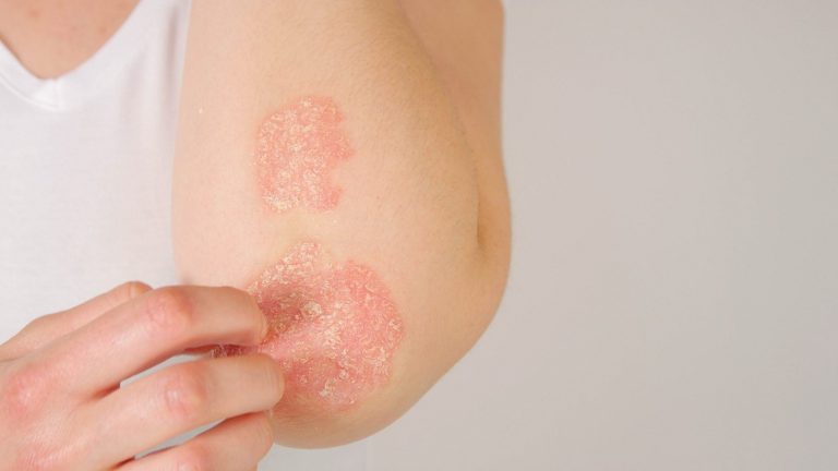 The Difference Between Psoriasis and Eczema - Medical Monks